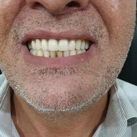 دندانسازی (ساخت دندان مصنوعی تعمیر دندان مصنوعی )|خدمات آرایشگری و زیبایی|تهران, مشیریه|دیوار