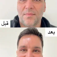 جشنواره پاییزه جراحی زیبایی پلک(بلفاروپلاستی)|خدمات آرایشگری و زیبایی|تهران, قیطریه|دیوار