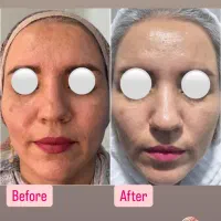 روشن سازی با لیزر پیکوشور و پاک کردن تتو|خدمات آرایشگری و زیبایی|هندیجان, |دیوار