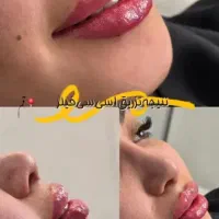 تزریق ژل بوتاکس نخ لیفت فیلر بادی یوسفی مقدم