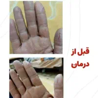 درمان پسوریازیس یا صدفک با گیاهان درمانی|آرایشی، بهداشتی، درمانی|اهواز, دانشگاه چمران|دیوار