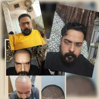 میخوای تضمینی باهزینه کمتر درشهر خودت کاشت مو کنی|خدمات آرایشگری و زیبایی|یزد, |دیوار