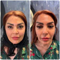 جشنواره لیفت تخصصی صورت با نخ و کانتورینگ|خدمات آرایشگری و زیبایی|بروجرد, |دیوار