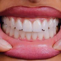 دندان پزشکی،روکش،کامپوزیت دندان،درمانی،اقساط