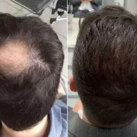 پرپشتی مو در ۷روز