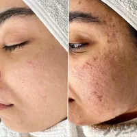 *پاکسازی پوست *فیشال صورت* کربوکسی تراپی *