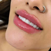 ژل و بوتاکس جشنواره تخفیف  سی سی ۷۰۰
