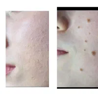 آموزش فیشیال تخصصی. مزو جوانساز صورت|خدمات آموزشی|کوهدشت, |دیوار