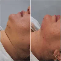 تزریق فیلر بوتاکس ساکشن چربی وتزریق چربی|خدمات آرایشگری و زیبایی|کرمانشاه, |دیوار