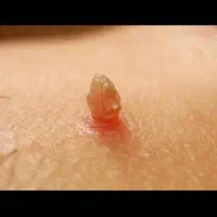 بهبود کامل زگیل تناسلی تضمینی