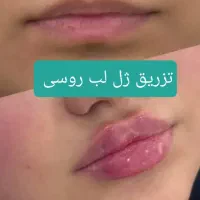ژل و بوتاکس و فیلر و پی آرپی