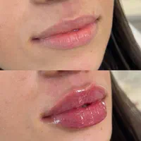 آنزیم ترکیبی بینی، لیفت بینی ژل کانتور صورت لب مزو|خدمات آرایشگری و زیبایی|تهران, سعادت‌آباد|دیوار
