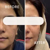 تزریق مزوژل بلانک بی ضد لک تخصصی