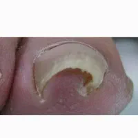 اصلاح ناخن کج/حجامت/فصد خون/میخچه