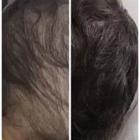 هیرفیلر مو دکتر CYJ