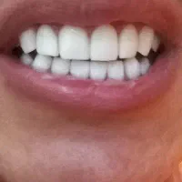 کامپوزیت و زیبایی...