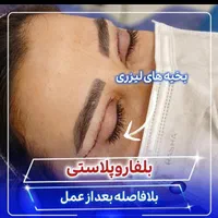 بلفاروپلاستی(جراحی پلک بالا و پایین)توسط چشم پزشک|خدمات آرایشگری و زیبایی|یاسوج, |دیوار
