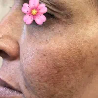 مدل برای درمان تخصصی پوست