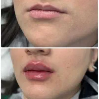 تزریق و بوتاکس توسط پزشک