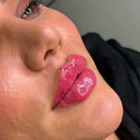 تزریق ژل لب فیلر بوتاکس کانتورینگ آنزیم لیفت صورت