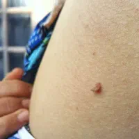 محلول درمان زگیل و زگیل تناسلی|آرایشی، بهداشتی، درمانی|میناب, |دیوار