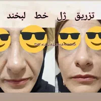 مطب دکتر کژال شاه ویسی تزریق ژل بوتاکس مزوژل