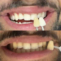 روشن شدن  3 درجه رنگ‌دندان در ۲۰ دقیقه