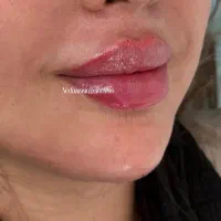 جشنواره تزریق ژل مادلینگ آقایان