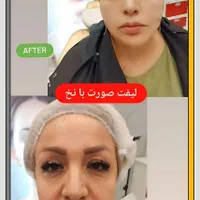 تزریق فیلر بوتاکس نخ لیفت بلفاروپلاستی توسط پزشک|خدمات آرایشگری و زیبایی|تبریز, |دیوار