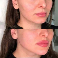 تزریق ژل / بوتاکس|خدمات آرایشگری و زیبایی|اردبیل, |دیوار