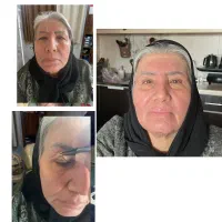 عمل زیبایی پلک(بلفاروپلاستی)جراحی غبغب توسط پزشک