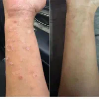 خودایمنی پسو