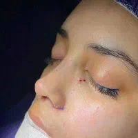 عمل جراحی بینی فقط ۲۴ میلیون|خدمات آرایشگری و زیبایی|قم, باغ شازده|دیوار