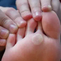 خال خالبرداری لیپوم غده چربی میخچه میلیا تگ پوستی|خدمات آرایشگری و زیبایی|تهران, صادقیه|دیوار