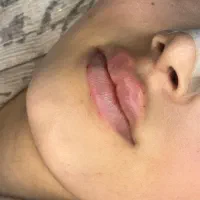 مدل ژل و بوتاکس پیرسینگ|خدمات زیبایی و سلامت|تهران, عبدلآباد|دیوار