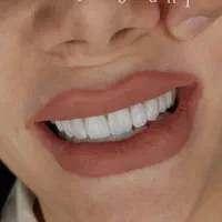 جشنواره بمناسبت روز مادر ایمپلنت، عصب کشی، جراحی،|خدمات آرایشگری و زیبایی|مشهد, شریف|دیوار