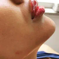 پی آر پی پوست مو و زانو پلاسمای خون PRP