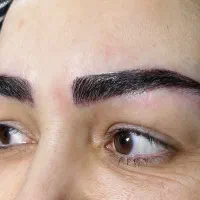 کاشت مو و کاشت ابرو زیر نظر پزشک متخصص