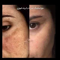 ژل بوتاکس چال لپ فیلربیکینی مزوتراپی پیرسینگ|خدمات آرایشگری و زیبایی|اسلام‌شهر, زرافشان|دیوار