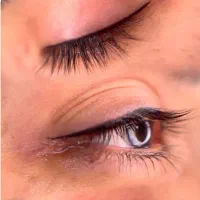 میکروپیگمنتیشن. میکرو بلیدینگ