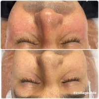 تخفیف ویژه فیشیال،تعداد محدود درکلینیک زیبایی نویا