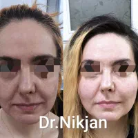 فیلر/بوتاکس/لب روسی/جوانساز/مزوژل مطب دکتر نیک جان|خدمات آرایشگری و زیبایی|رشت, گلسار|دیوار