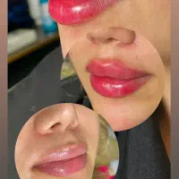 جشنواره ژل و بوتاکس و پی ار پی در مطب توسط پزشک|خدمات آرایشگری و زیبایی|شیراز, چوگیاه|دیوار