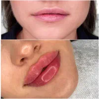 بوتاکس ژل نخ بلفاروپلاستی مزو چربی|خدمات آرایشگری و زیبایی|اصفهان, مولوی|دیوار