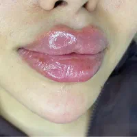 پیرسینگ،میکرودرمال،چال‌لپ،ژل