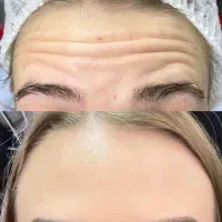 بوتاکس ، فیلر ، پی آر پی و مزو تراپی تخصصی