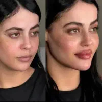 فول فیس ۳۵۰۰‌،بوتاکس ۵۹۰ توسط پزشک+دوسیسی ژل هدیه