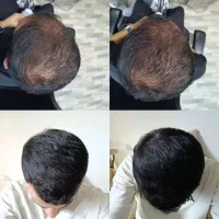 رویش مجدد مو سر