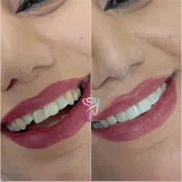 دندانپرشکی رز کامپوزیت روکش لمینت دندان|خدمات آرایشگری و زیبایی|قرچک, شهرک طلائیه|دیوار