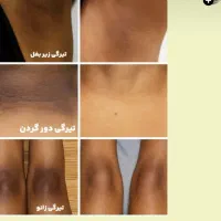 لیزر حذف تتو و روشن کنندگی بدن